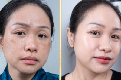 Trị Nám Sâu Bằng Laser Pico – Hiệu Quả Nhanh & Bền Lâu