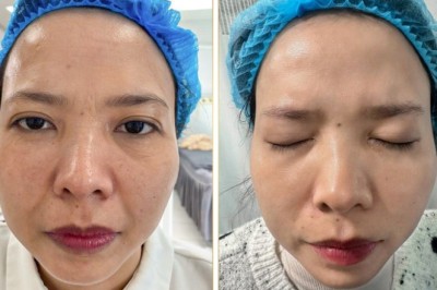 Điều trị nám nội tiết an toàn – Hiệu quả chuẩn y khoa | thegioikhoedep.com