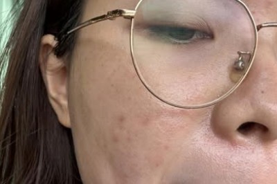 Trị Mụn Ẩn An Toàn – Da Sáng Mịn, Không Lồi Lõm | Thegioikhoedep.com