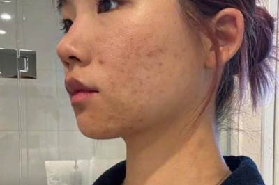 Trị Mụn Đầu Đen Hiệu Quả – Lỗ Chân Lông Sạch Mịn | Thegioikhoedep.com