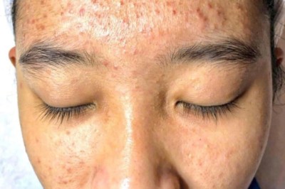 Trị Mụn Viêm Hiệu Quả – Ngăn Ngừa Thâm Sẹo | Thegioikhoedep.com