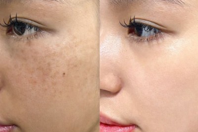 Trị Nám Bằng Niacinamide & Collagen – Làm Sáng Da, Giảm Thâm Nám