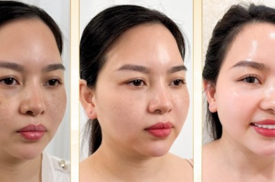 Trị Nám Bằng Vitamin C & Peeling – Làm Sáng Da, Ngăn Tái Phát