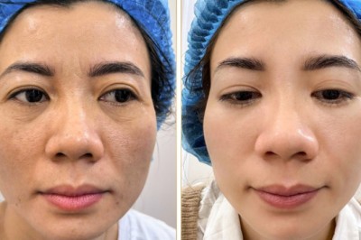 Trị Nám Hiệu Quả Bằng Meso Therapy & Laser – Da Sáng Khỏe, Ngăn Tái Phát