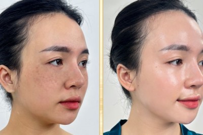 Trị nám mảng hiệu quả – Giải pháp an toàn, ngăn tái phát, bác sĩ khuyên dùng