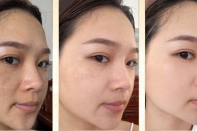 Nám hỗn hợp: Giải pháp điều trị hiệu quả, an toàn và tiết kiệm chi phí trên thegioikhoedep.com