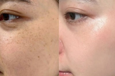 Nám sau sinh – Nguyên nhân, cách điều trị an toàn cho mẹ bỉm, liệu trình chuẩn y khoa trên thegioikhoedep.com