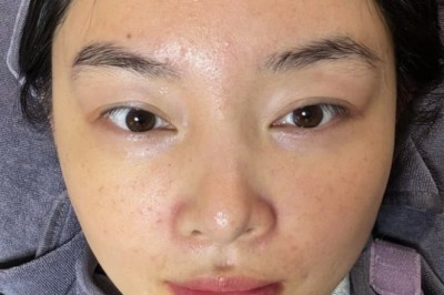 Trị Mụn Cằm – Kiểm Soát Nội Tiết, Da Mịn | Thegioikhoedep.com