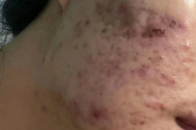 Trị Mụn Má Hiệu Quả – Giảm Viêm, Không Thâm Sẹo | Thegioikhoedep.com