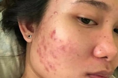 Trị Mụn Trán Hiệu Quả – Da Sạch, Lỗ Chân Lông Nhỏ | Thegioikhoedep.com