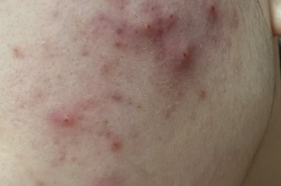 Trị Mụn Tuổi Dậy Thì – Ngăn Ngừa Thâm, Giữ Da Khỏe Đẹp | Thegioikhoedep.com